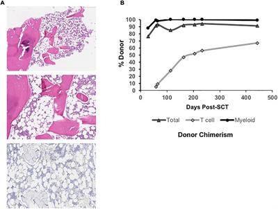 Non-myeloablative conditioning is sufficient to achieve complete donor myeloid chimerism following matched sibling donor bone marrow transplant for myeloproliferative leukemia virus oncogene (MPL) mutation-driven congenital amegakaryocytic thrombocytopenia: Case report